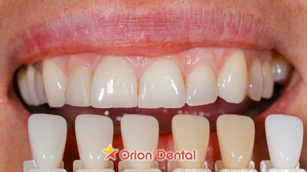 Stock image of a close-up of a person's smile beside a row of veneer shade samples