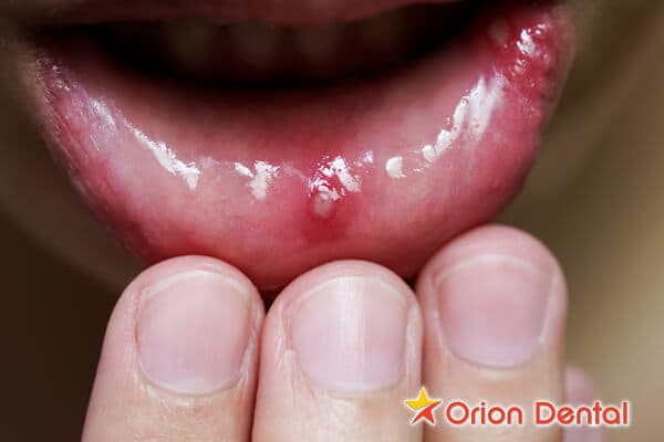 Stock image of a person touching their lip
