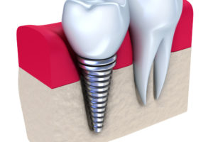 Implant solutions for Teeth replacement