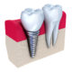 A Dental Shift: Implants Instead of Bridges