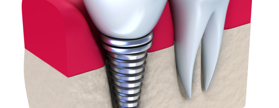 Implant solutions for Teeth replacement