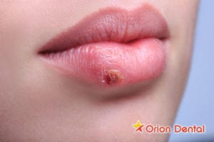 Orion Dental - how your dentist can help you treat a cold sore