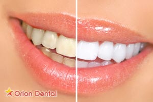 Orion Dental - is teeth whitening safe?