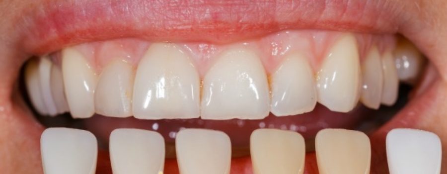Orion Dental - why choose veneers