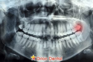Understanding wisdom teeth removal
