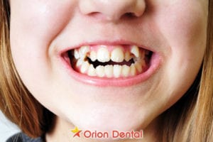 Orion Dental - Common Types of Bite Problems Explained