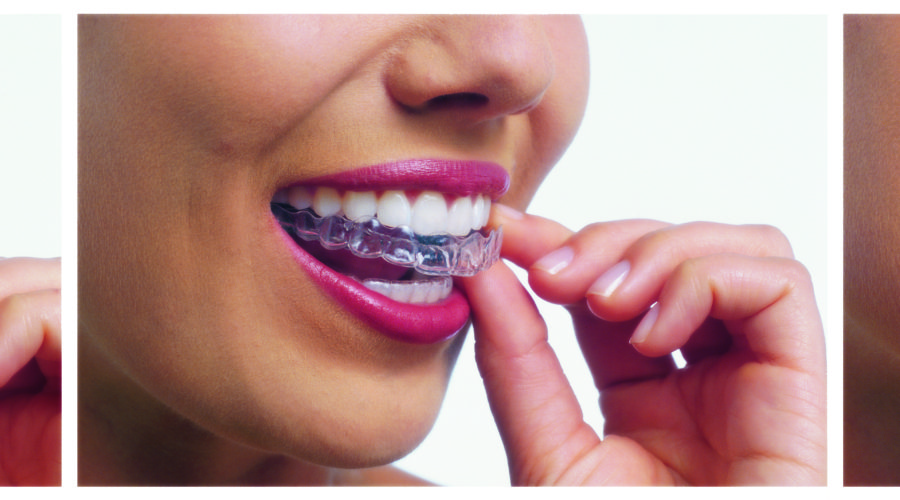 Invisalign Aligners Orion Dental