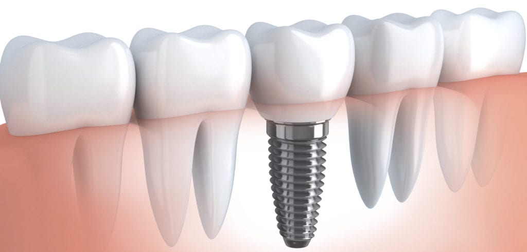 Dentist Dental implants Milton | Dentist Dental implants Scarborough