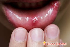 Orion Dental : Canker Sores Treatments, Causes & Prevention