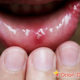Canker Sores Treatments, Causes & Prevention