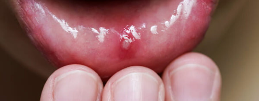 Canker Sores Treatments, Causes & Prevention - Orion Dental