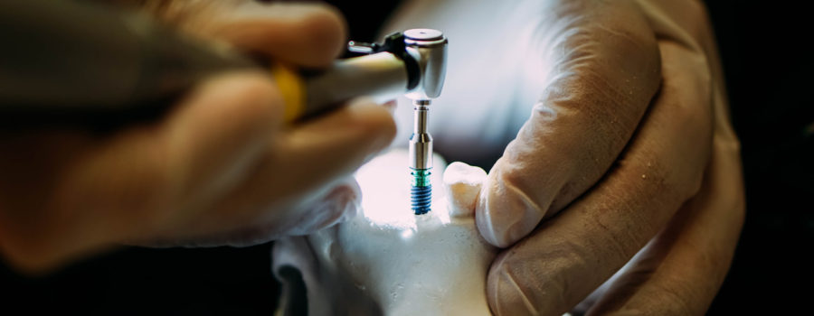 Dental Implants Benefits | Orion Dental