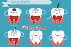 Orion :: Root Canal