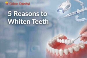 5 Reasons to Whiten Teeth Professionally with a Dentist